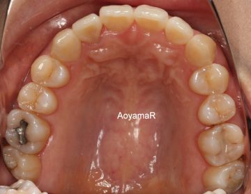 上顎前歯の捻転