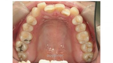 上下顎狭窄による前歯部叢生