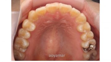 側切歯の反対被蓋