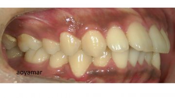 上下歯列アーチ非対称を伴う叢生