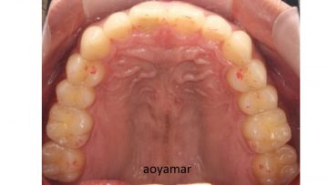上下歯列アーチ非対称を伴う叢生