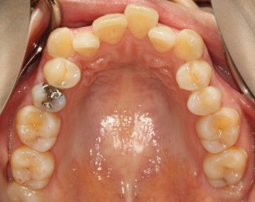 乳臼歯晩期残存による上下顎前突