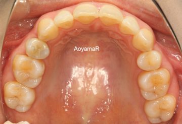乳臼歯晩期残存による上下顎前突