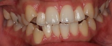 小臼歯4本抜歯によるオープンバイト治療