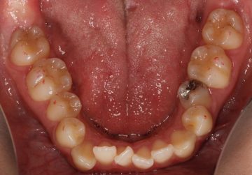 小臼歯4本抜歯によるオープンバイト治療