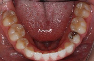 小臼歯4本抜歯によるオープンバイト治療