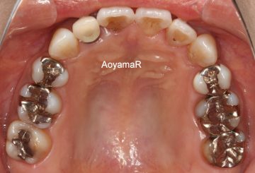 重度の叢生を伴う上下顎前突
