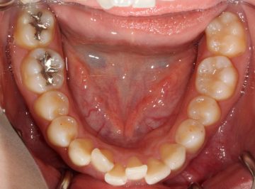 上下小臼歯4本抜歯による治療