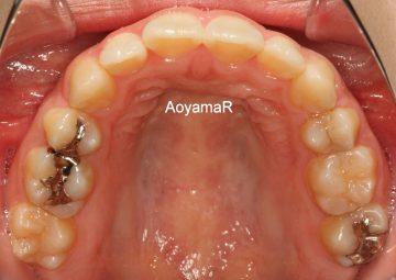 上下小臼歯4本抜歯による治療