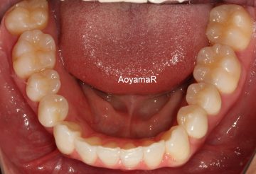 下顎の左側偏位を伴う重度のそう生
