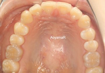 フルクラスⅡ上顎前突ケース