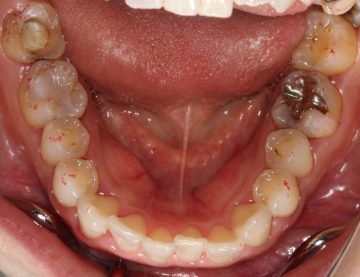 大臼歯関係Ⅱ級による上顎前突