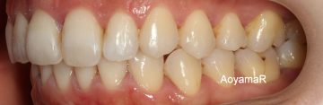 大臼歯関係Ⅱ級による上顎前突