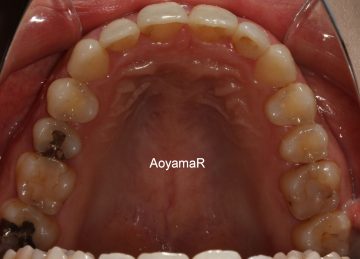 大臼歯関係Ⅱ級による上顎前突
