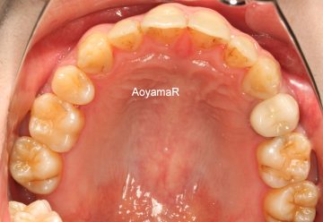 上顎左側臼歯晩期残存