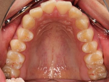 上顎遠心移動による非抜歯治療