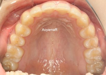 上顎遠心移動による非抜歯治療
