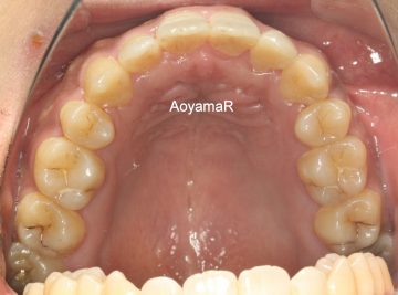 骨格的3級、小臼歯4本抜歯ケース