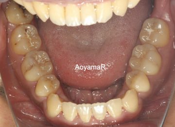 骨格的3級、小臼歯4本抜歯ケース