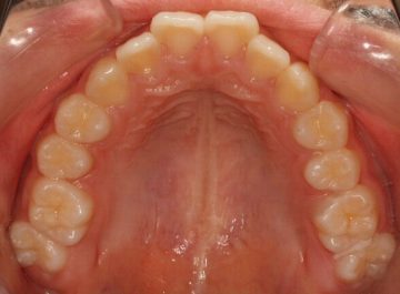 上顎小臼歯2本抜歯による治療