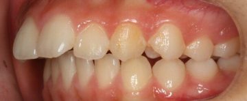 上顎小臼歯2本抜歯による治療