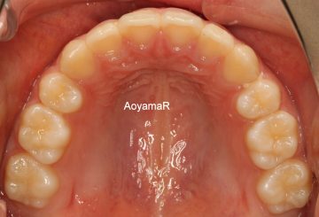 上顎小臼歯2本抜歯による治療