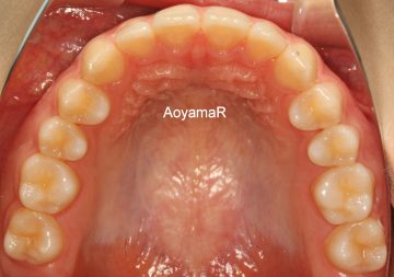 上顎前歯てい出によるディープバイト
