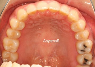 ディープバイトを伴う空隙歯列