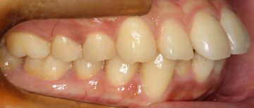 上下小臼歯4本抜歯による治療