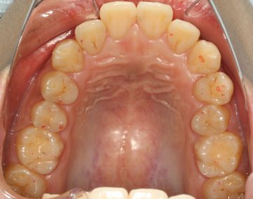 上下小臼歯4本抜歯による治療