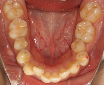 上下小臼歯4本抜歯による治療