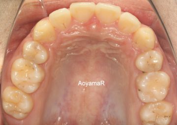 上下小臼歯4本抜歯による治療
