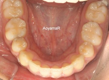 上下小臼歯4本抜歯による治療