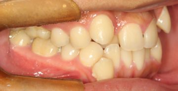 重度のそう生、小臼歯4本抜歯による治療