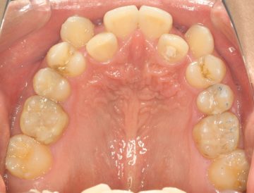 重度のそう生、小臼歯4本抜歯による治療
