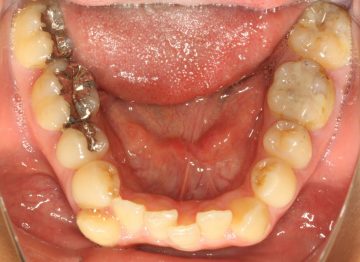 重度のそう生、小臼歯4本抜歯による治療