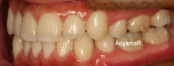 重度のそう生、小臼歯4本抜歯による治療