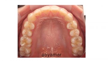 小臼歯交叉咬合を含む叢生