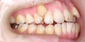 クラスⅢ、小臼歯4本抜歯による治療