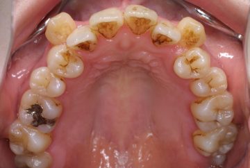 クラスⅢ、小臼歯4本抜歯による治療