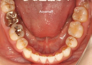 クラスⅢ、小臼歯4本抜歯による治療