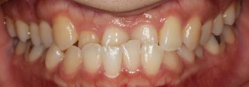 重度下顎前突の非抜歯治療