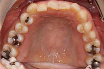 重度下顎前突の非抜歯治療