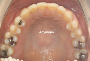 重度下顎前突の非抜歯治療