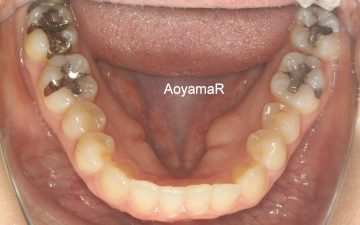 重度下顎前突の非抜歯治療